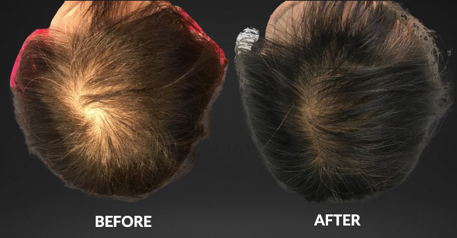 Top-down hair comparison labeled before and after, showing thinning hair becoming denser and darker.