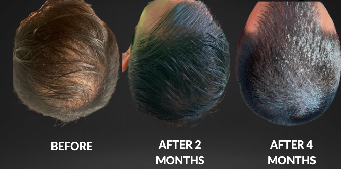 Three top-view hair photos labeled before, after 2 months, and after 4 months, showing denser hair over time