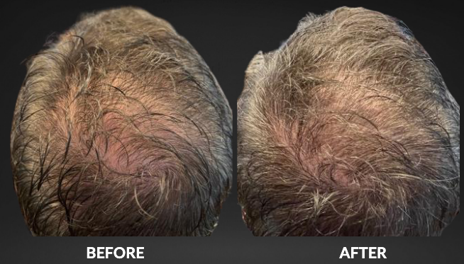 Top of a scalp shown in before-and-after hair loss treatment comparison.