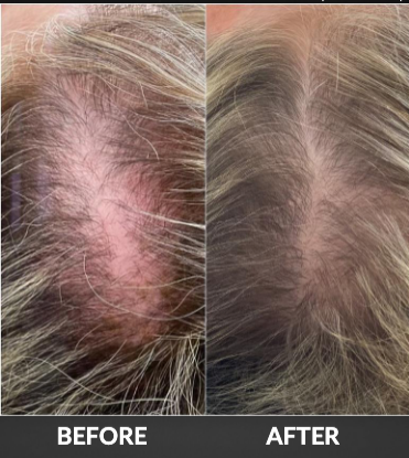 Scalp before-and-after comparison showing reduced redness and irritation after treatment