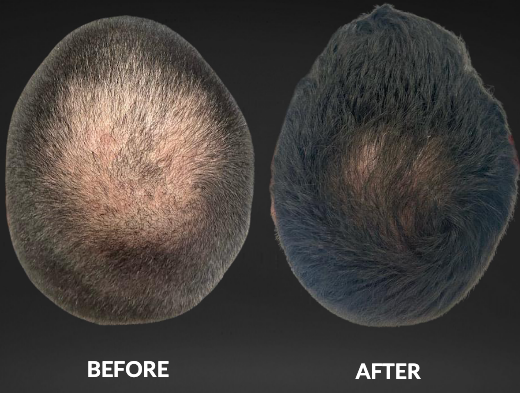 Top-down comparison of thinning hair before and after treatment, labeled “BEFORE” and “AFTER”