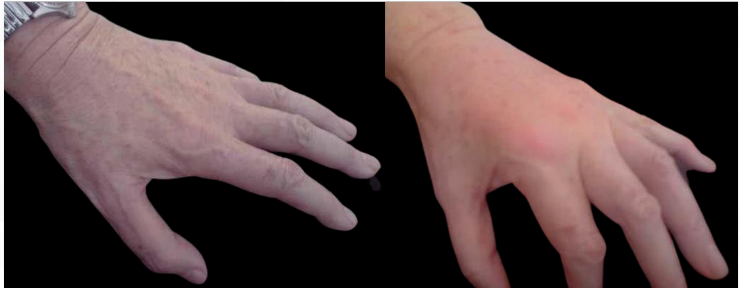 Two hands on a black background: one pale, one reddened, showing color contrast.