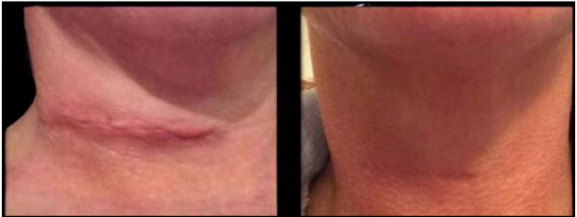 Side-by-side close-ups of a neck showing red, irritated skin and a skin fold rash