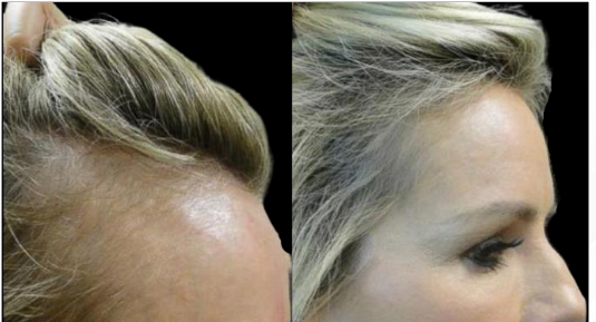 Side-by-side close-up of a blonde hairstyle with a high forehead line and slicked-back hair on top