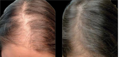 Side-by-side scalp close-ups showing thinning hair on the left and fuller hair on the right