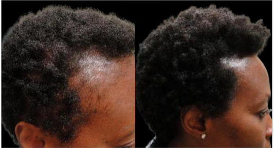 Close-up side-by-side views of a person’s head showing short curly hair and a thinning patch on the scalp