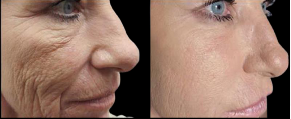 Side-by-side profile of a wrinkled face before and after smoothing skin treatment