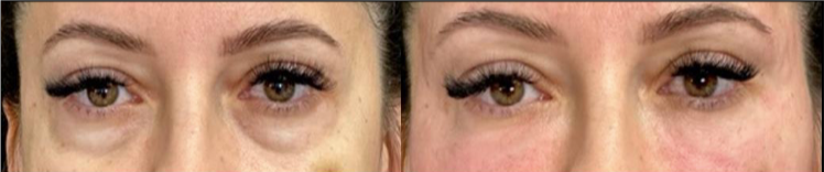 Close-up comparison of under-eye skin before and after treatment, with reduced dark circles and redness