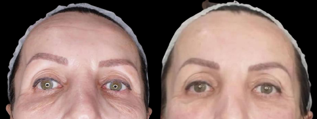 Side-by-side close-up of the same face, with one eye area and skin tone visibly different before and after treatment