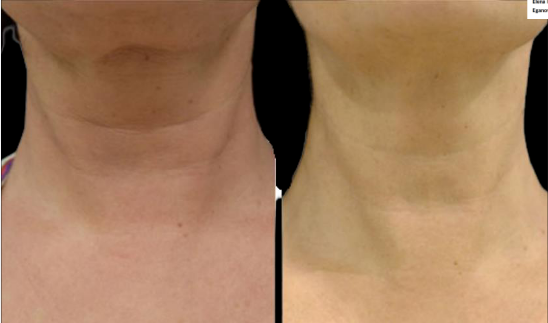 Side-by-side close-up of a neck before and after treatment, showing reduced redness and smoother skin