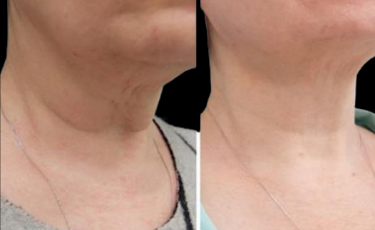 Side-by-side close-ups of a neck and lower face, showing skin before and after treatment.