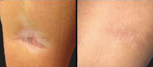 Close-up of a healed scar on skin, shown before and after treatment side by side.