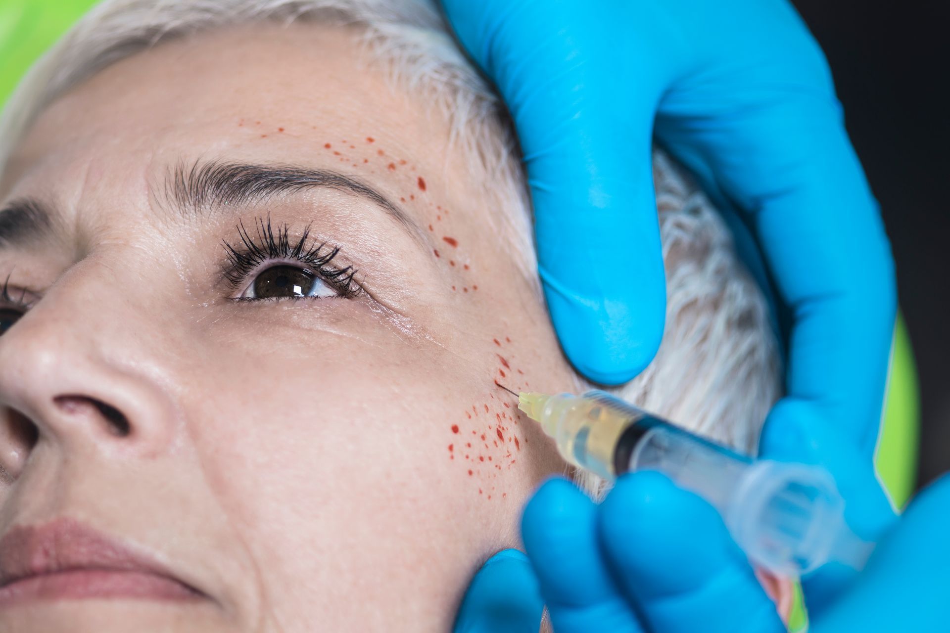 Gloved hands inject facial filler into a woman’s cheek with a syringe