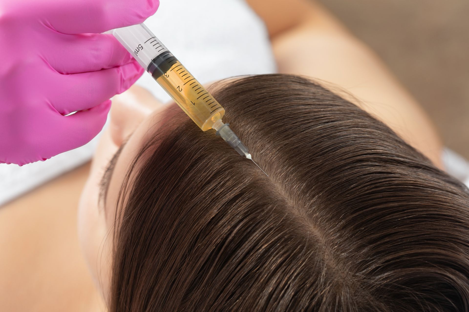 Gloved hand injecting scalp with syringe during hair treatment procedure