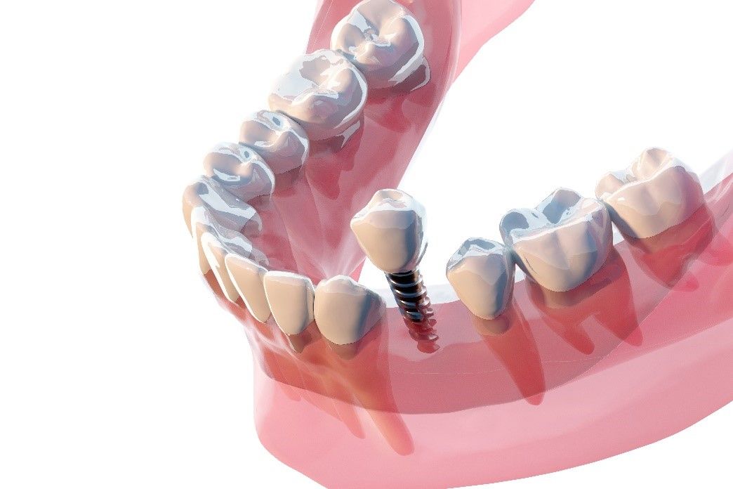 Dental Implants | 3D Render of Jaw With Dental Implant
