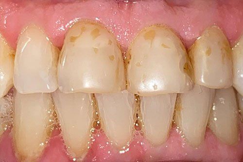After invisalign treatment in Cicinnati OH