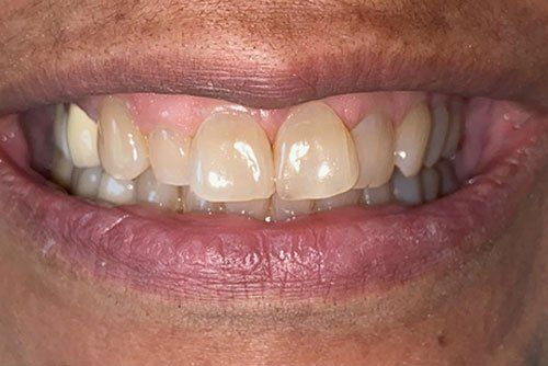 After invisalign treatment in Cicinnati OH