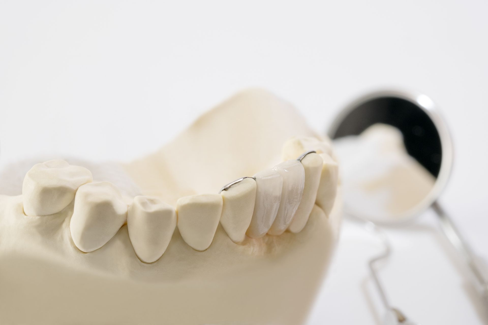 Maryland Bridge | Dental Bridges