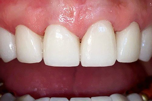 After invisalign treatment in Cicinnati OH