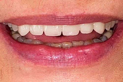 After invisalign treatment Cicinnati OH