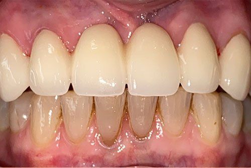 After invisalign treatment in Cicinnati OH