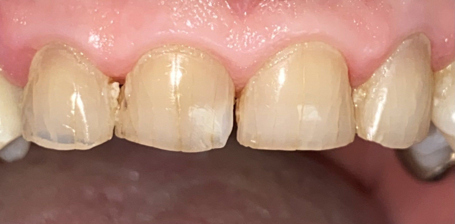 After invisalign treatment in Cicinnati OH