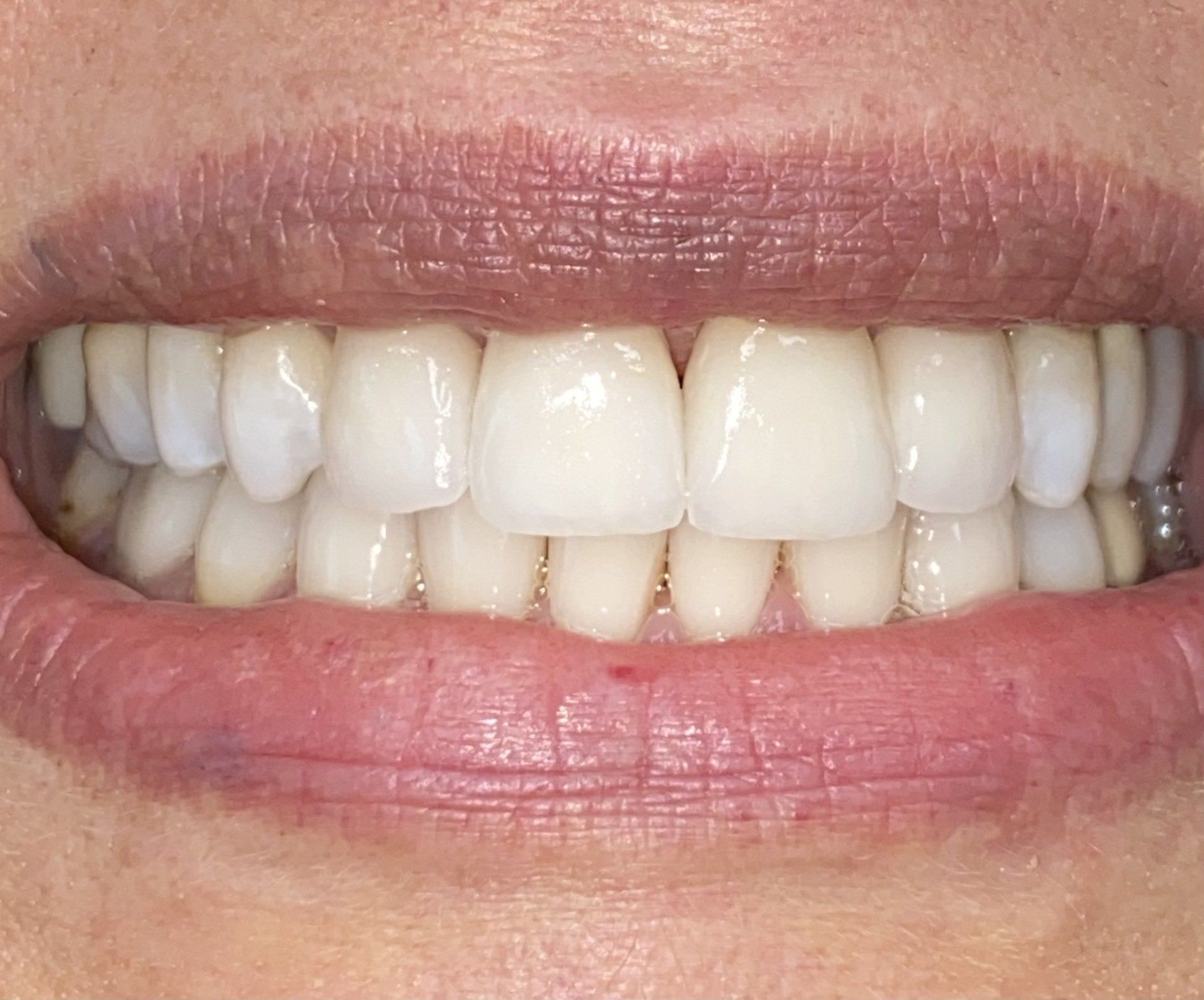After invisalign treatment in Cicinnati OH