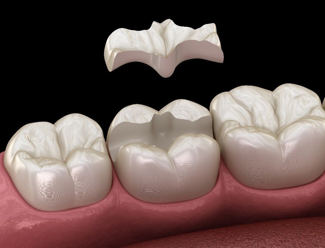Tooth Filling | Inlays and Onlays