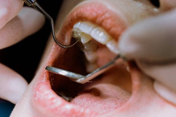 When Do You Need a Root Canal Treatment?