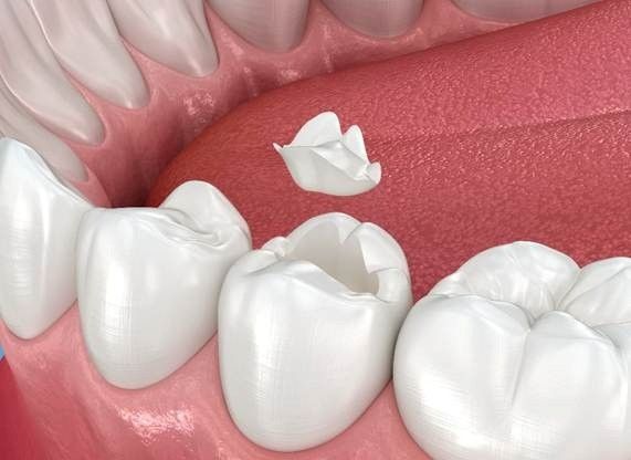 Dental Crowns