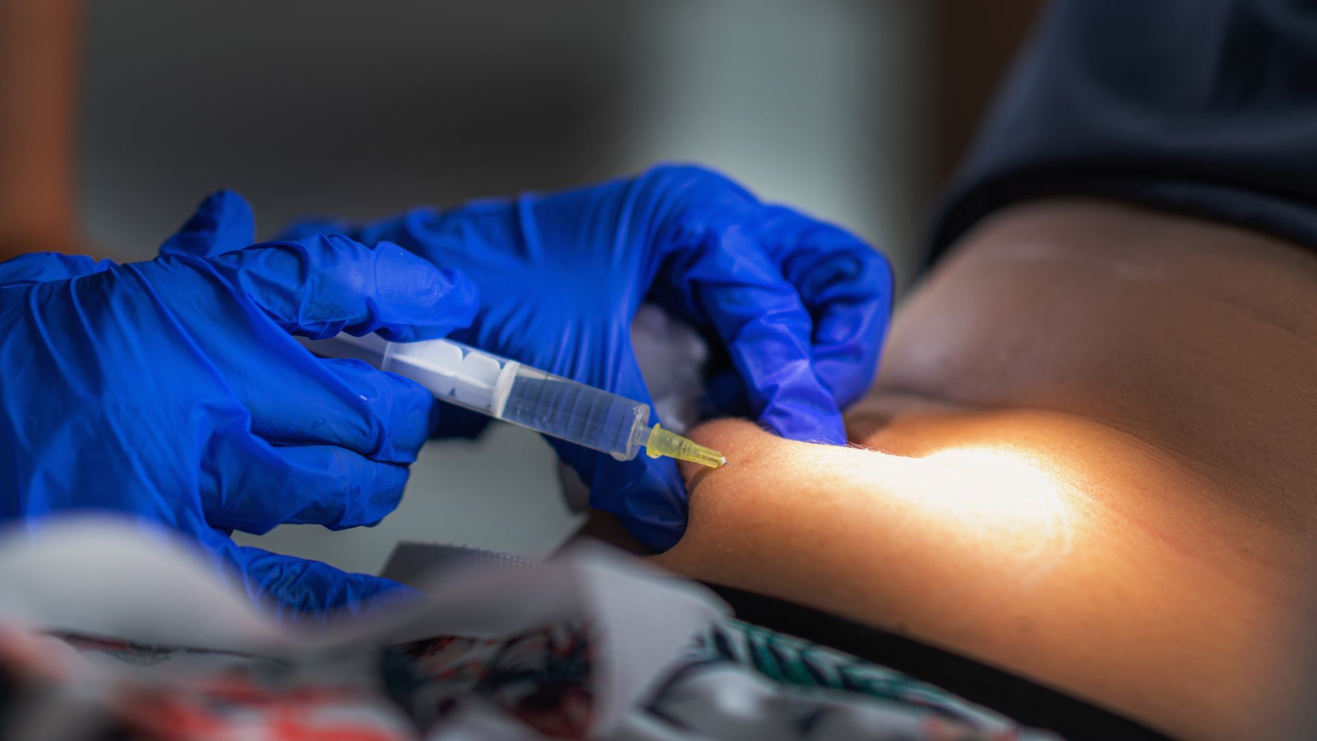 PCDC Lipo procedure