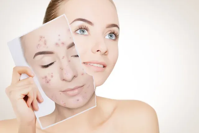 Expert acne treatments and skincare solutions in The Villages FL