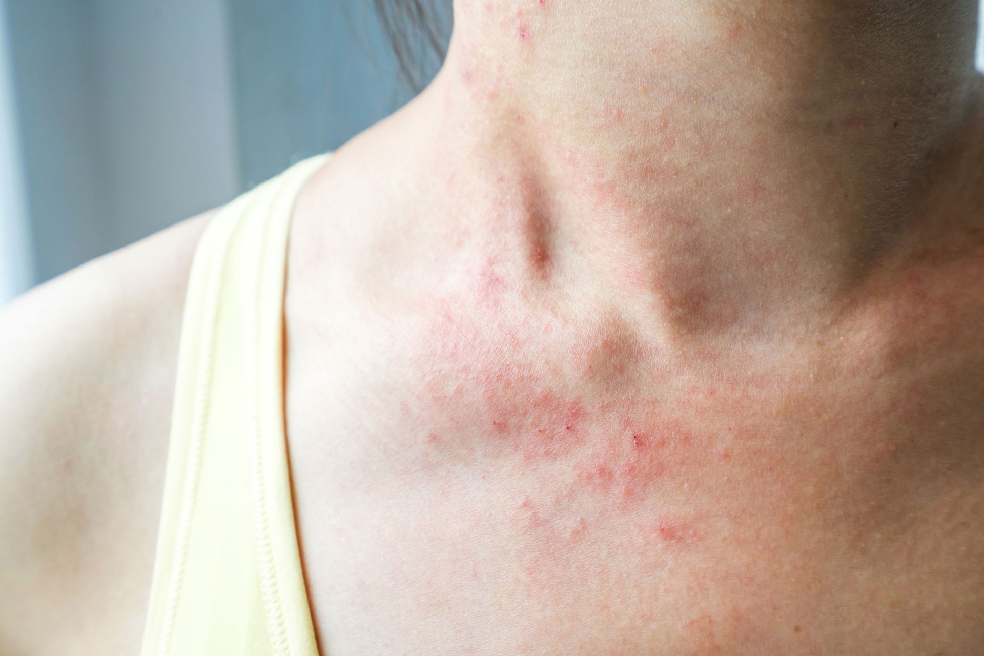 Expert acne treatments and skincare solutions in The Villages FL