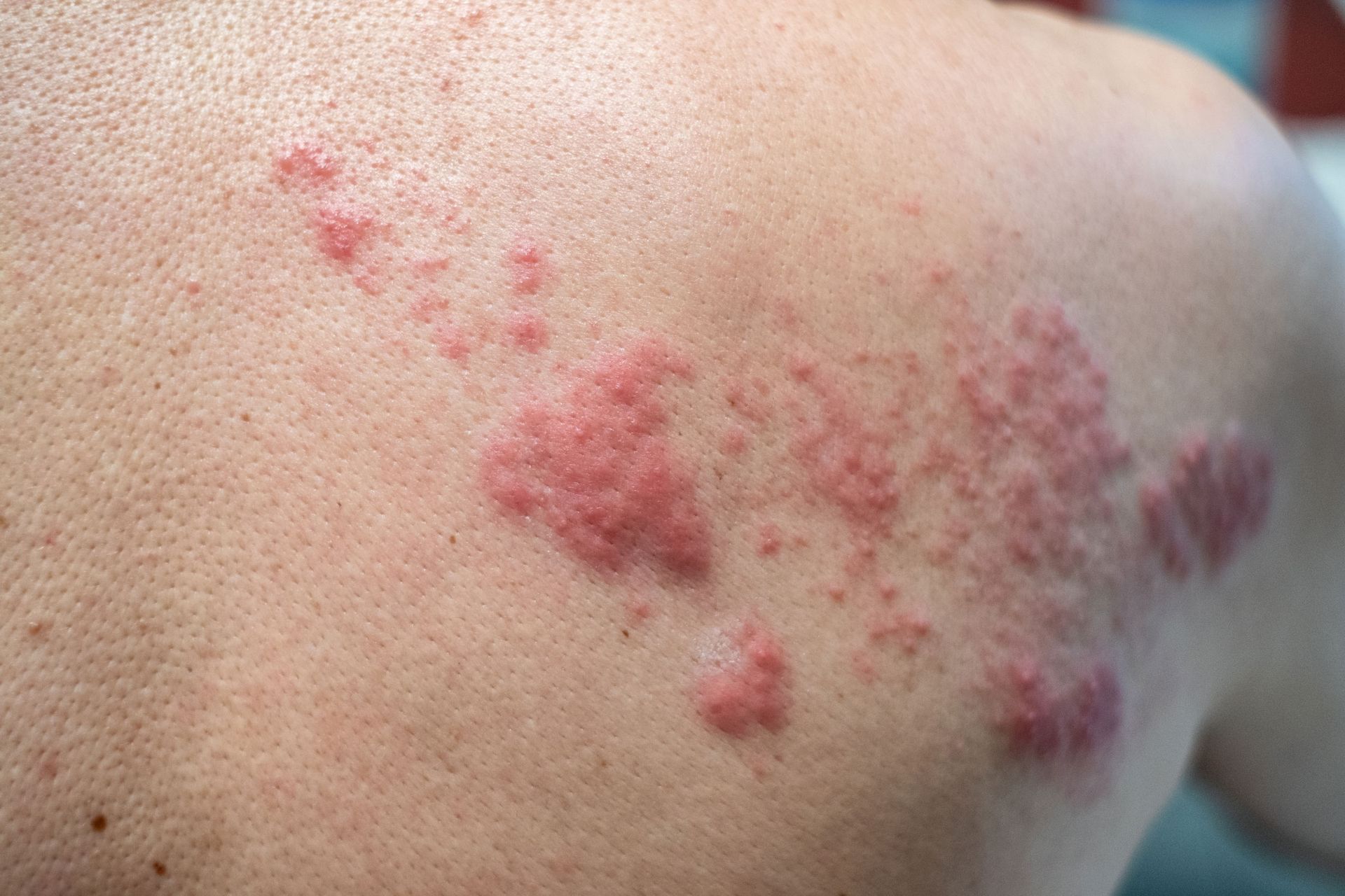 Eczema and rosacea treatments by board-certified dermatologists in Ocala