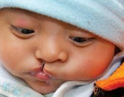 Close-up of a baby with a cleft lip, wrapped in a light blue blanket and wearing a white knit hat.
