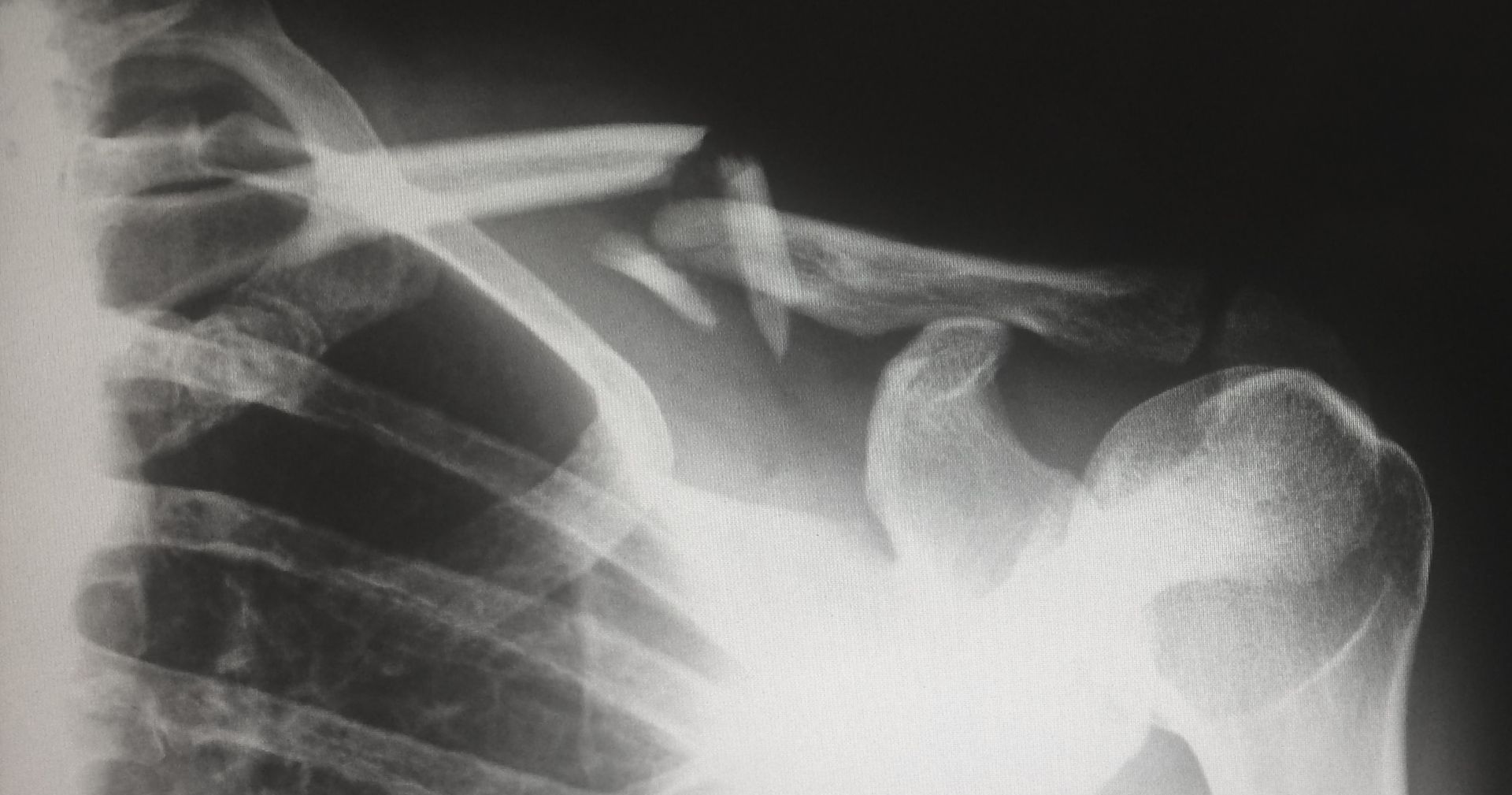 xray of broken bones