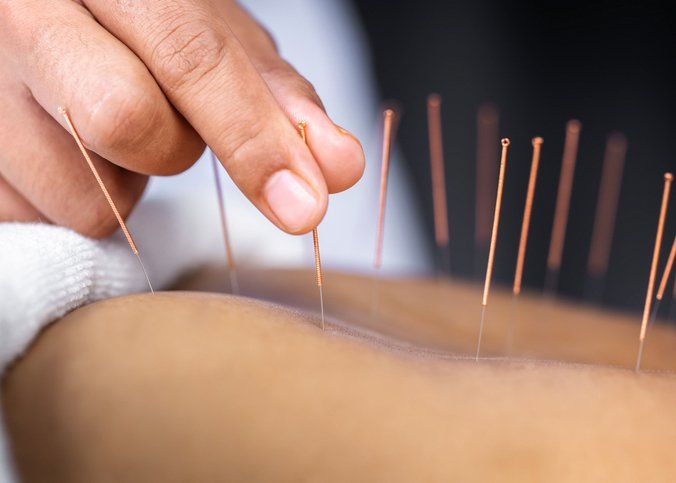 western acupuncture
