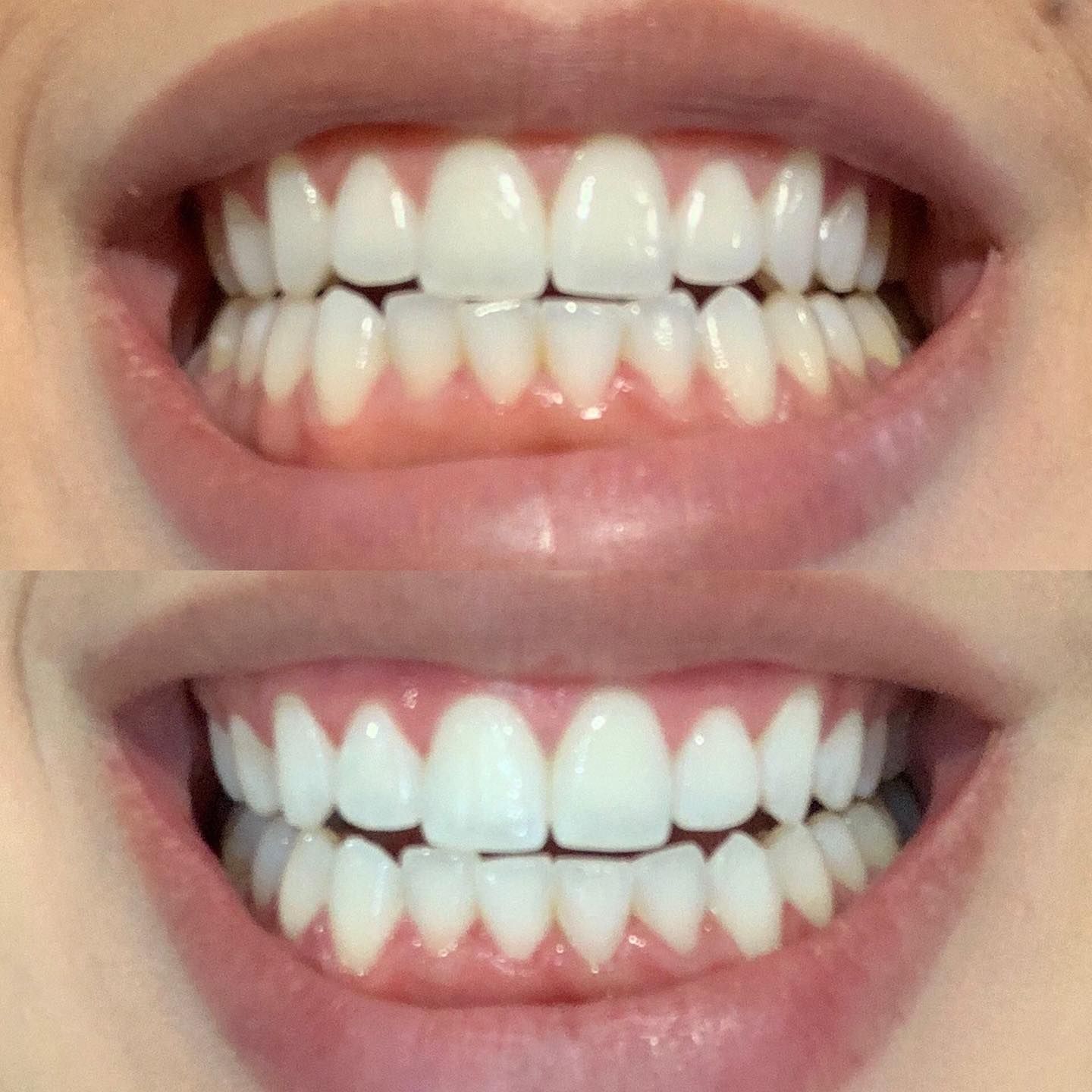 Close-up of two smiling mouths showing white teeth, one normal and one with a cool blue tint.