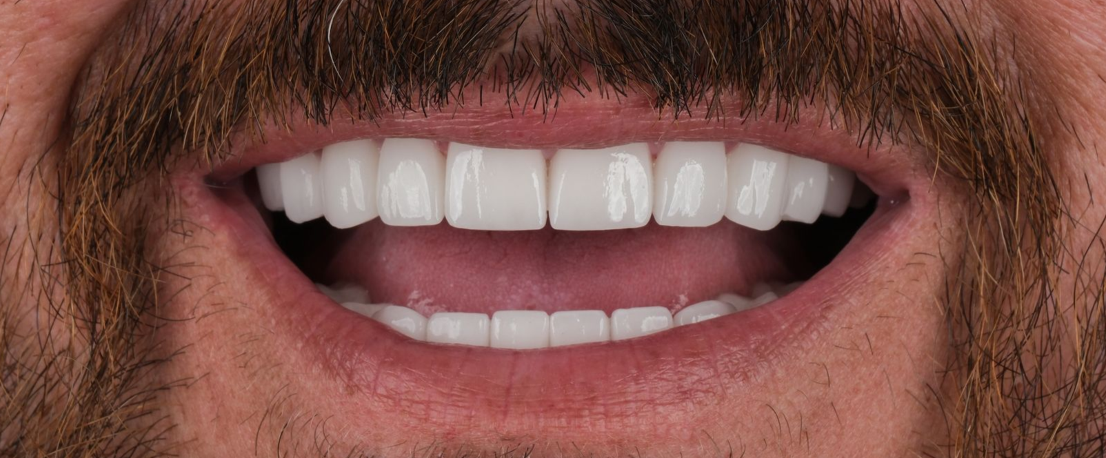 Close-up of a smiling man's mouth with perfect white teeth and a full, brown mustache.