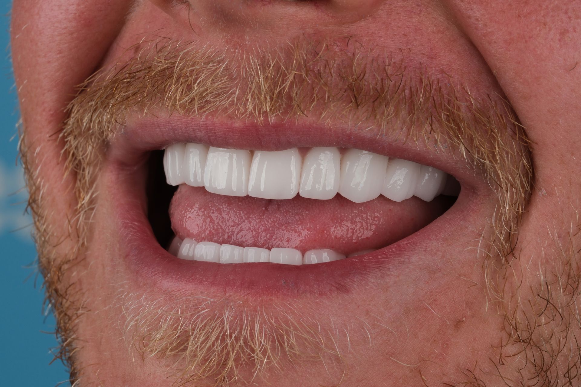 Man with a light beard showing bright, white teeth while opening his mouth and sticking out his tongue.