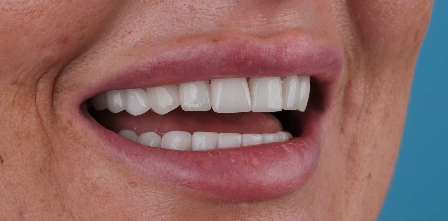 Close-up of a person's smiling mouth, showing straight, white teeth and pink lips.