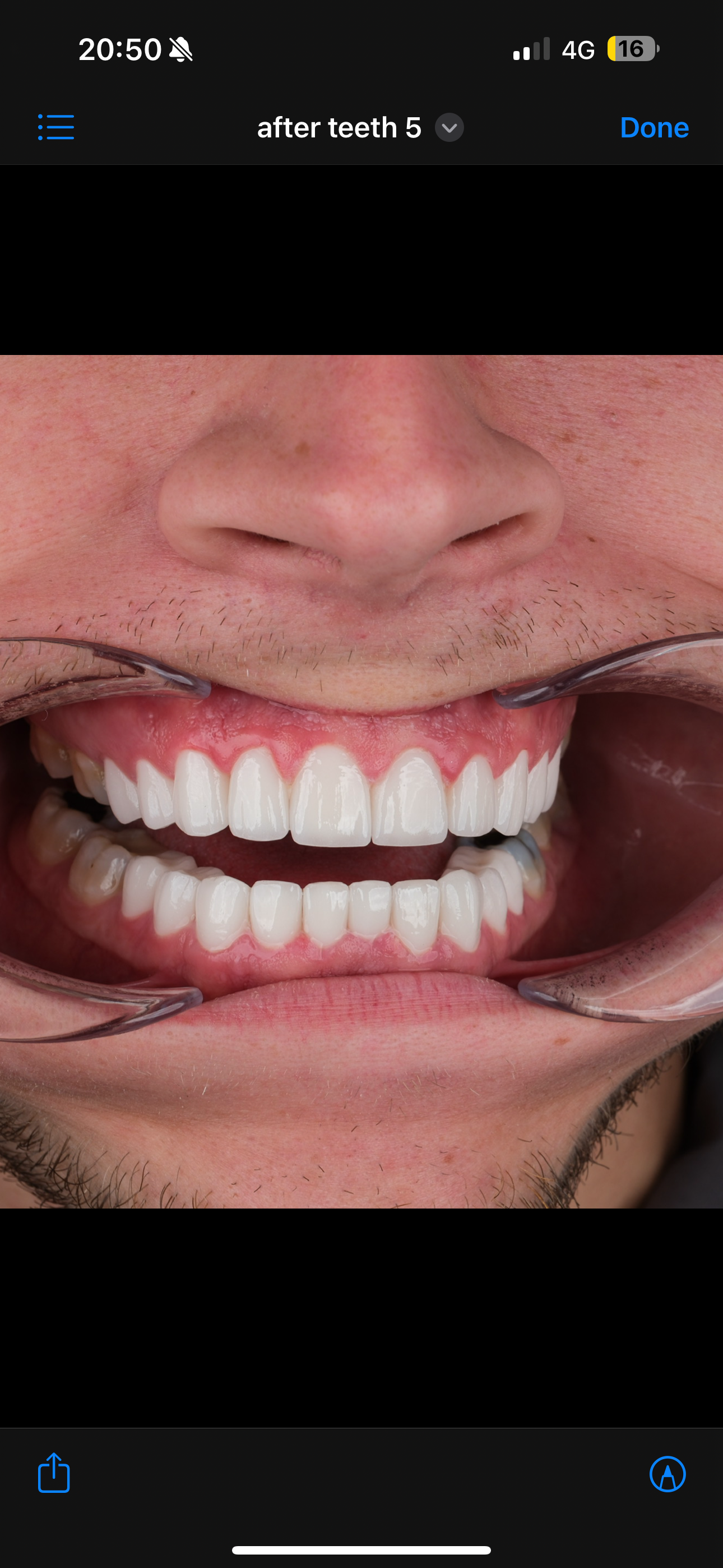 Close-up of a person's mouth. They are smiling, teeth are very white and straight. The gums are pink.