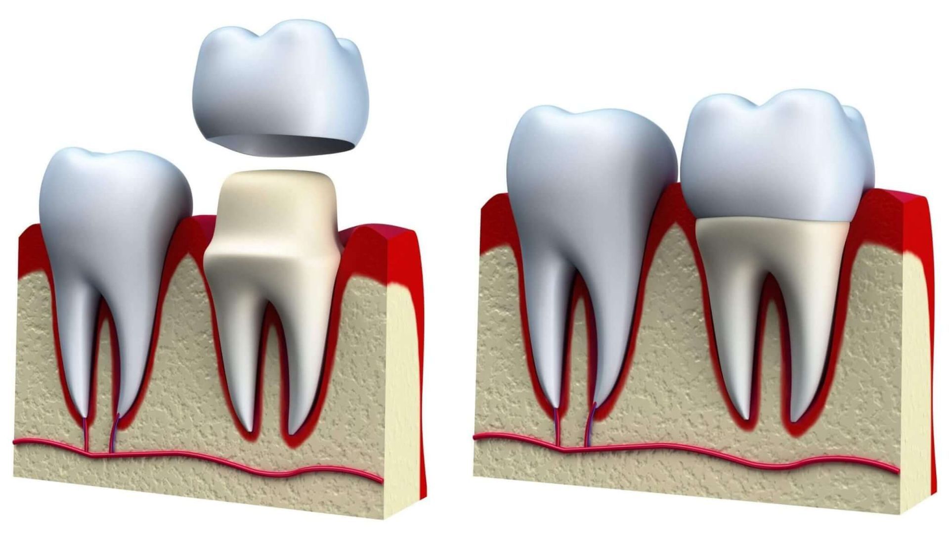 Diagram of a tooth being fitted with a crown. Shows the before and after placement of the crown.