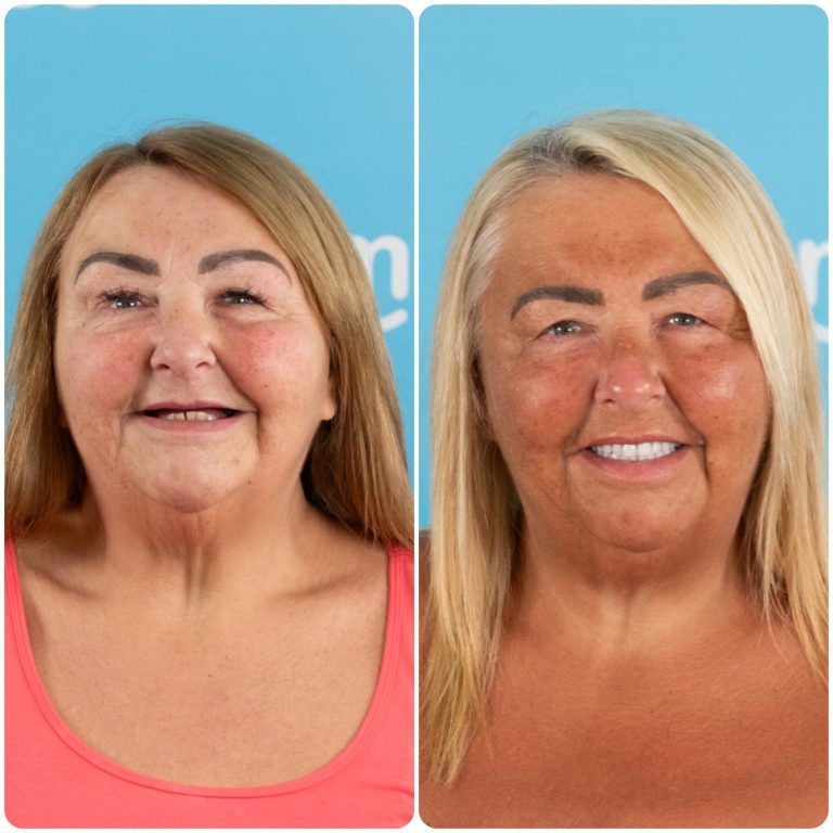 Side-by-side comparison: woman with fair skin and hair, then tanned skin and blonde hair; smiling against a blue background.