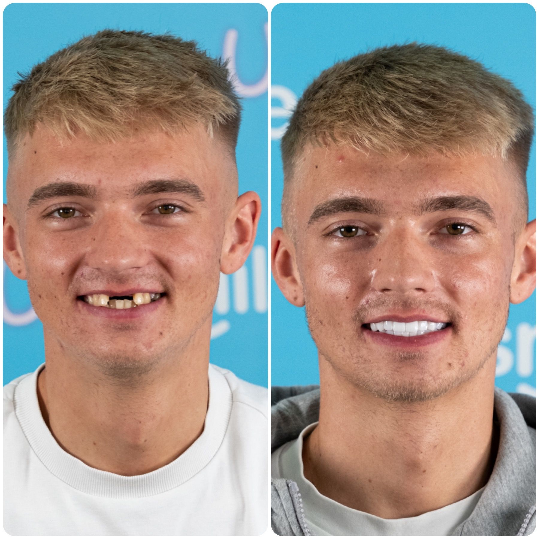 Before and after comparison: young man with missing teeth smiles, then smiles broadly with new, white teeth.