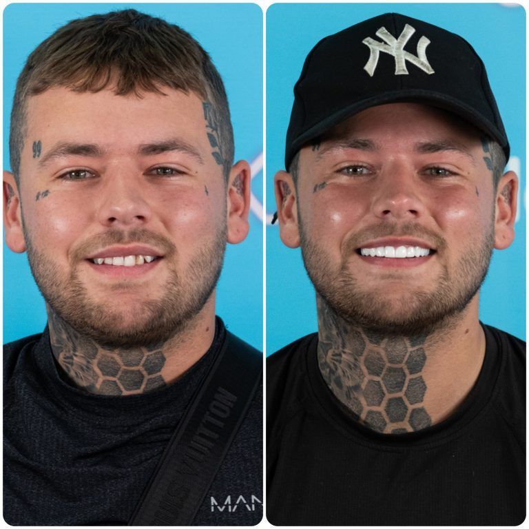 Side-by-side photos of a man; before with imperfect teeth, and after with a white smile and a baseball cap.