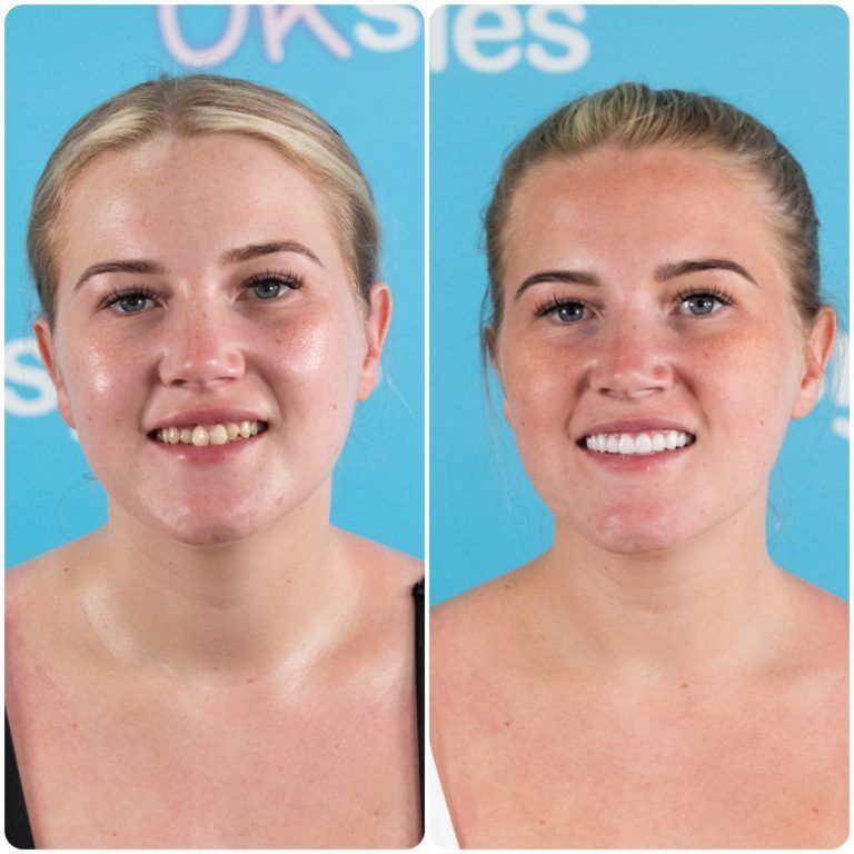 Before and after photos of a woman's smile, showing teeth improvement; blue background.