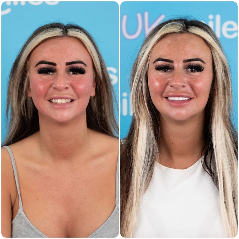 Woman before/after cosmetic dental work; smiling with fair skin, blonde highlights, and dark makeup.