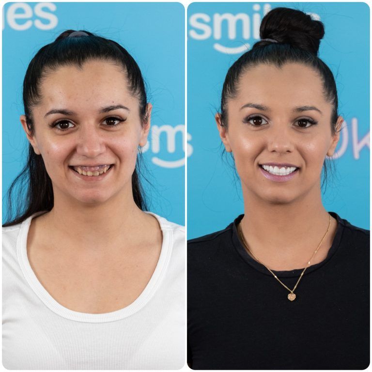 Side-by-side comparison of a woman before and after a dental procedure, smiling with improved teeth.