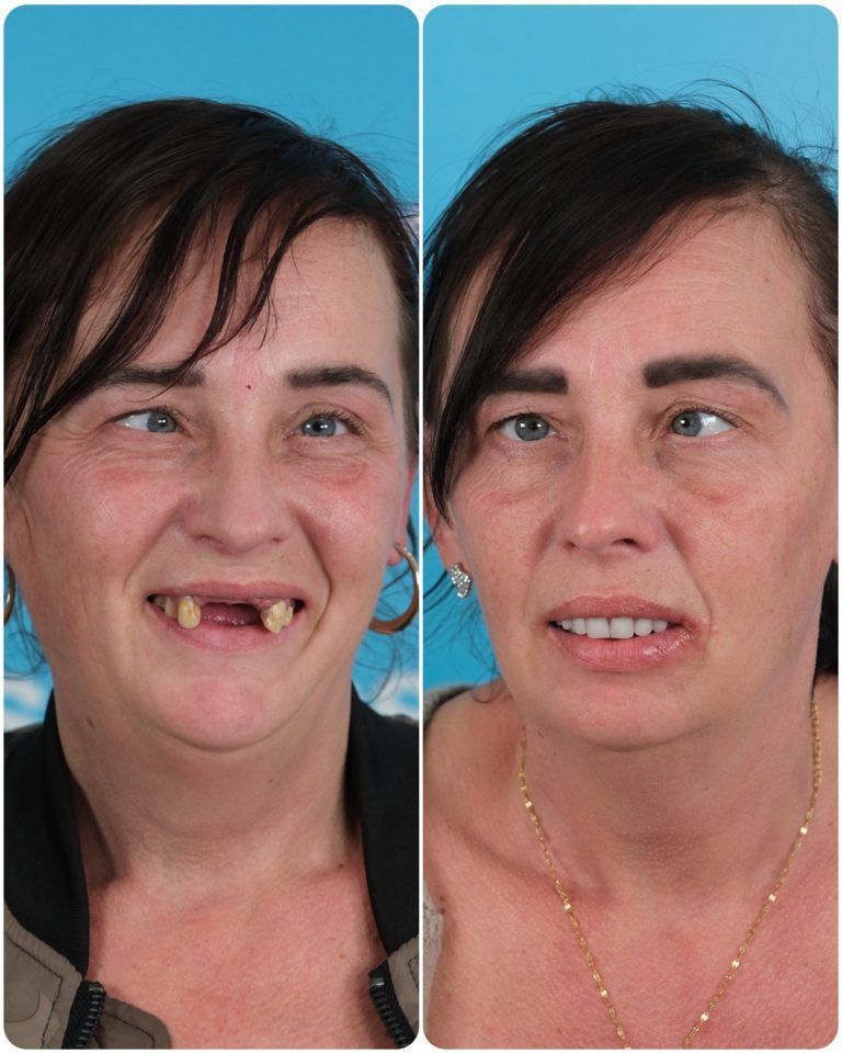 Woman's dental transformation: before and after. Showing missing teeth replaced by a new set, happier expression.